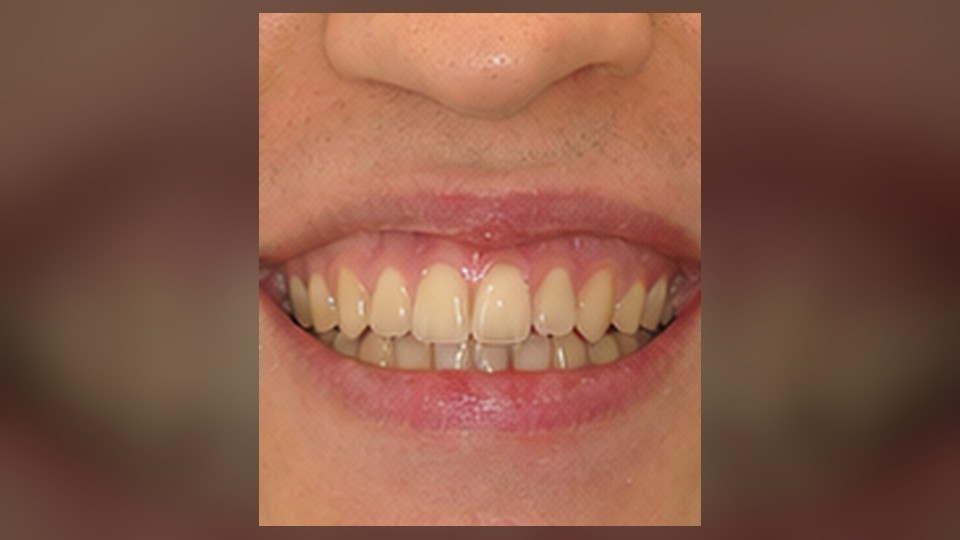 Corrección de mordida abierta anterior — resultado